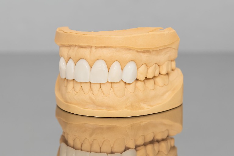 protesi e faccette dentali