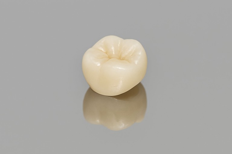 protesi e faccette dentali